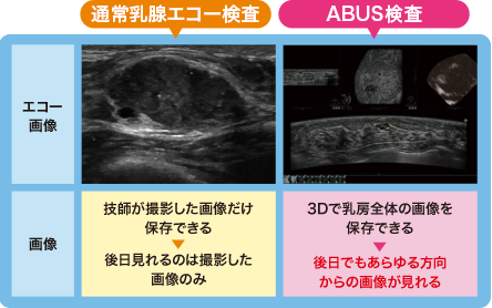 通常乳腺エコー検査、ABUS検査の比較画像