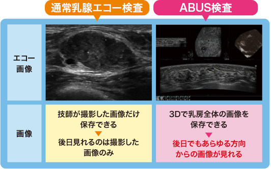 通常乳腺エコー検査、ABUS検査の比較画像